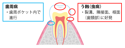 図1　う蝕と歯周病