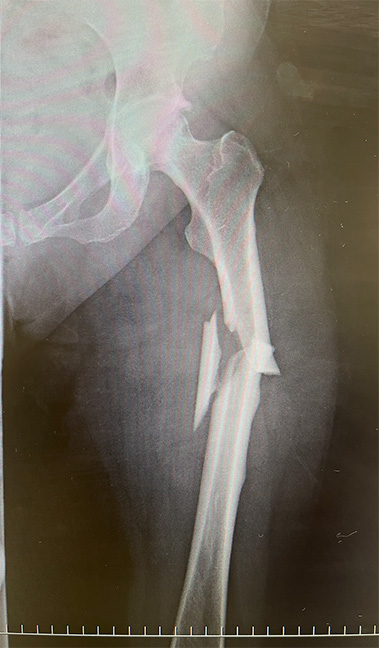 図1　71歳女性の左大腿骨非定型骨折（自験例）