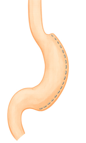 図1　腹腔鏡下スリーブ状胃切除術（LSG）のシェーマ