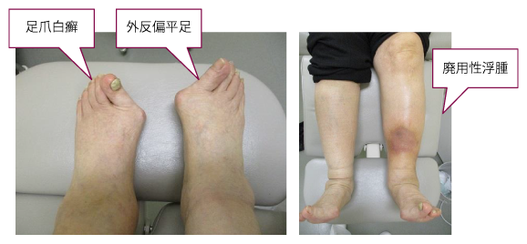 糖尿病患者の足を守る「足の疾患センターの役割」 ―前編 医師の