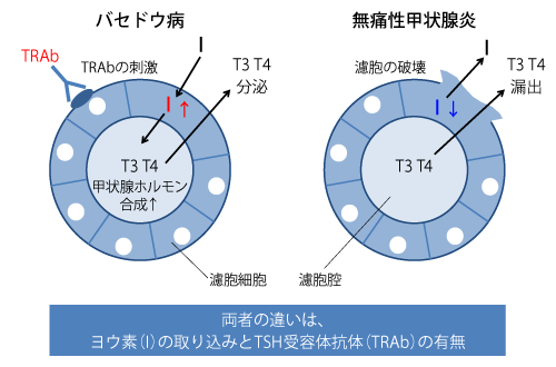 3．甲状腺中毒症の鑑別診断と治療 | 糖尿病・内分泌プラクティスWeb