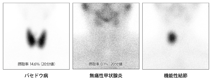 3．甲状腺中毒症の鑑別診断と治療 | 糖尿病・内分泌プラクティスWeb