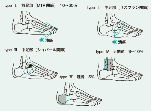 シャルコー関節症を診察したことがありますか？ | 糖尿病リソースガイド