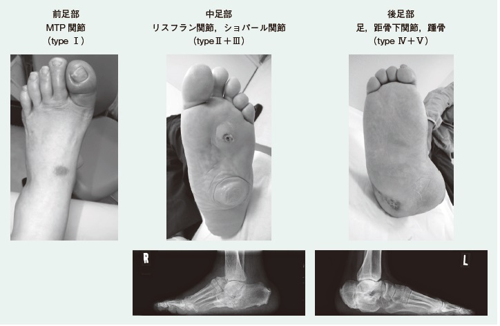 シャルコー関節症を診察したことがありますか？ | 糖尿病リソースガイド