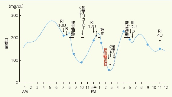 特別寄稿 わたしの「インスリン物語」～インスリンを最大限有効利用したい～ | 糖尿病リソースガイド