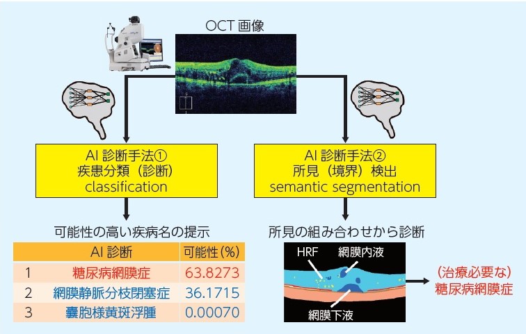 2．糖尿病網膜症診療におけるAI（artificial intelligence）の役割