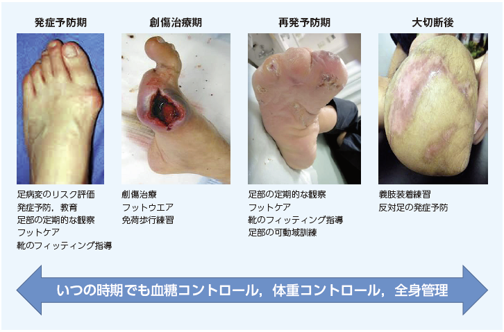 1．日常の内科外来診療でできること ─フットケアや糖尿病性足病変の集 