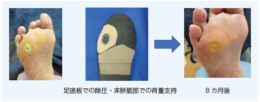 5．慢性足潰瘍患者や足病変ハイリスク患者の運動療法とは？ | 糖尿病 